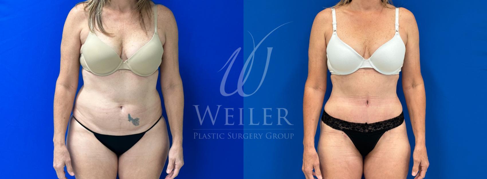 Before & After Tummy Tuck Case 1114 Front View in Baton Rouge, New Orleans, & Lafayette, Louisiana