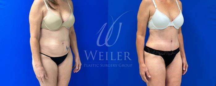 Before & After Tummy Tuck Case 1114 Right Oblique View in Baton Rouge, New Orleans, & Lafayette, Louisiana