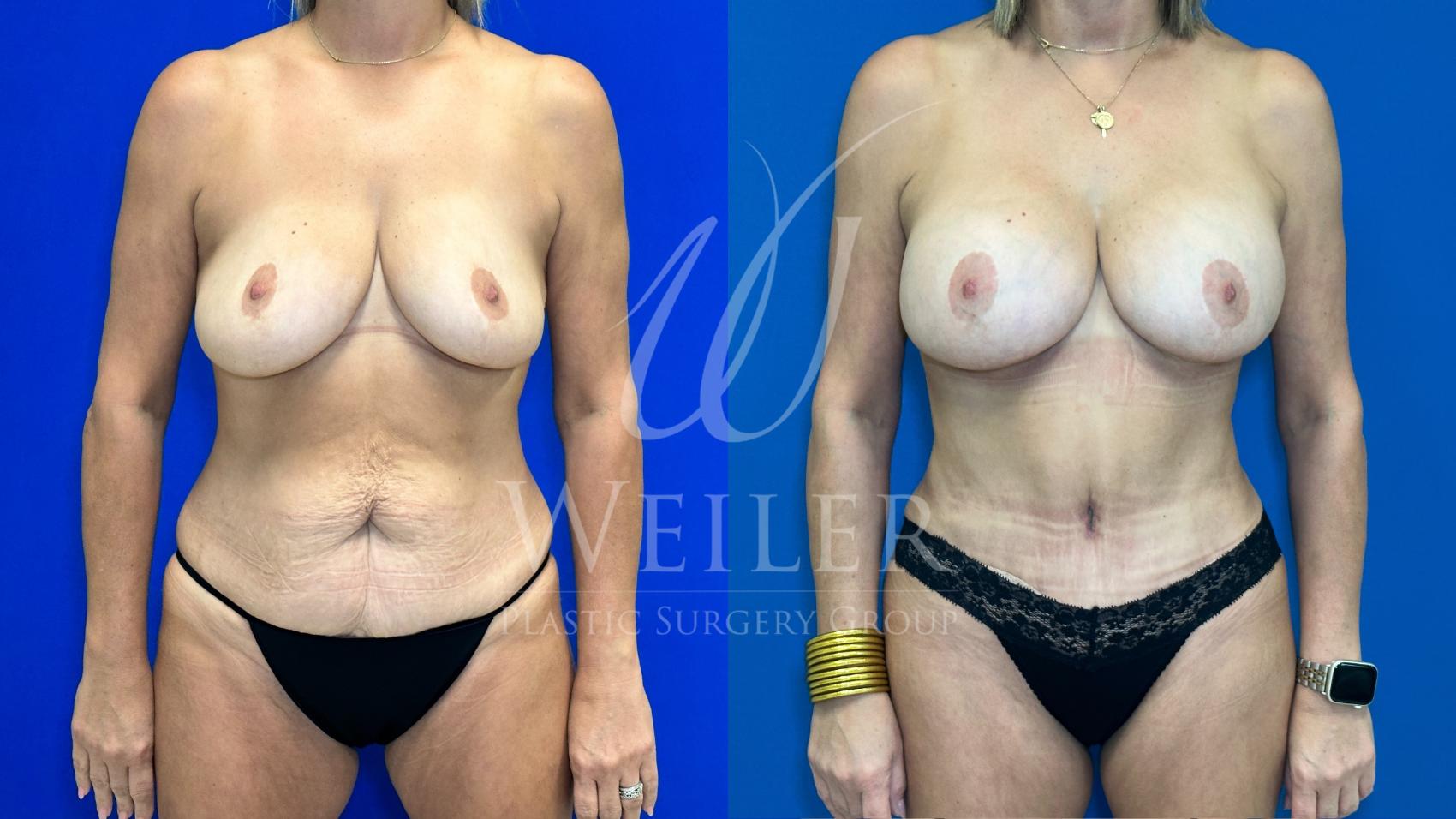 Before & After Tummy Tuck Case 1125 Front View in Baton Rouge, New Orleans, & Lafayette, Louisiana