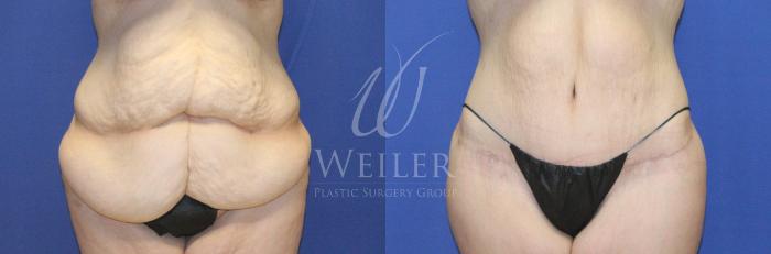 Before & After Tummy Tuck Case 1133 Front View in Baton Rouge, Louisiana
