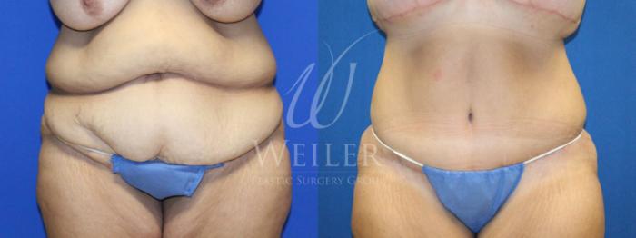 Before & After Tummy Tuck Case 1157 Front View in Baton Rouge, New Orleans, & Lafayette, Louisiana