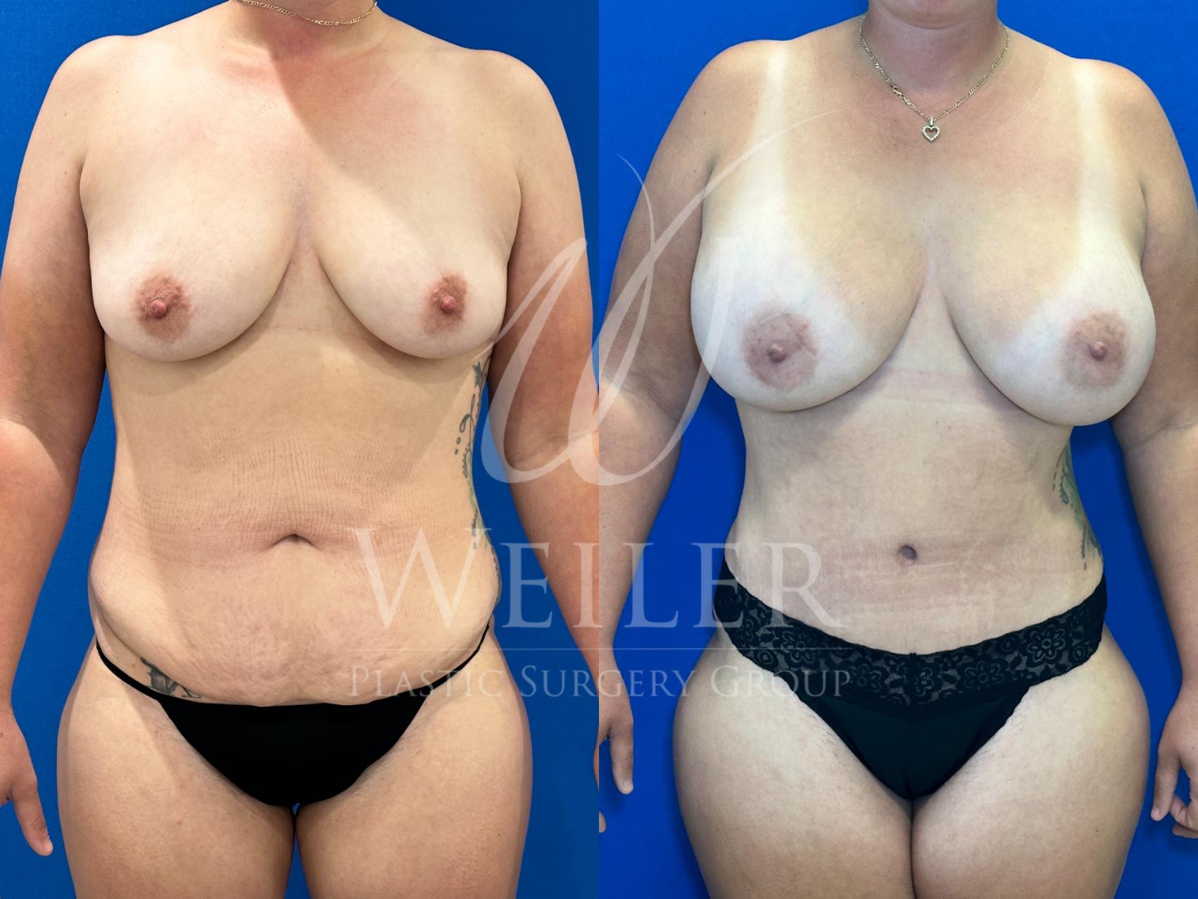 Before & After Tummy Tuck Case 1160 Front View in Baton Rouge, New Orleans, & Lafayette, Louisiana