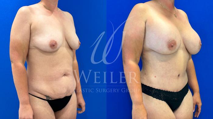 Before & After Tummy Tuck Case 1160 Left Oblique View in Baton Rouge, New Orleans, & Lafayette, Louisiana