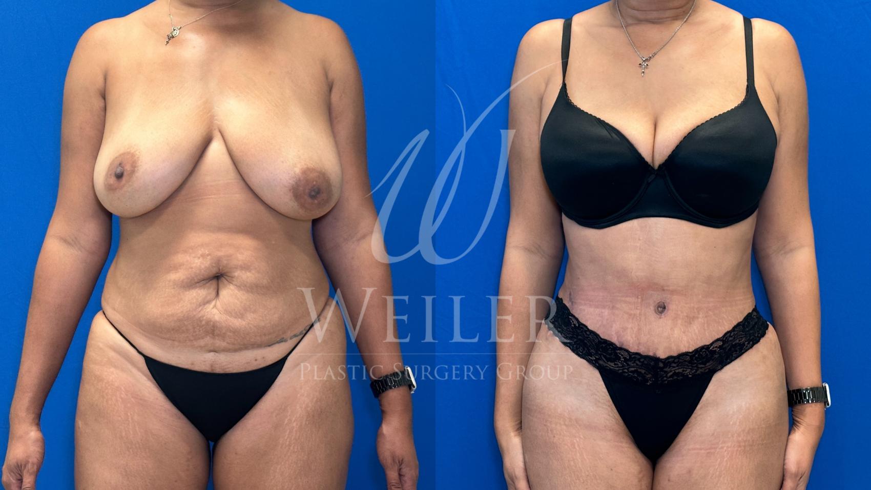 Before & After Tummy Tuck Case 1162 Front View in Baton Rouge, New Orleans, & Lafayette, Louisiana