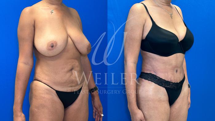 Before & After Tummy Tuck Case 1162 Right Oblique View in Baton Rouge, New Orleans, & Lafayette, Louisiana