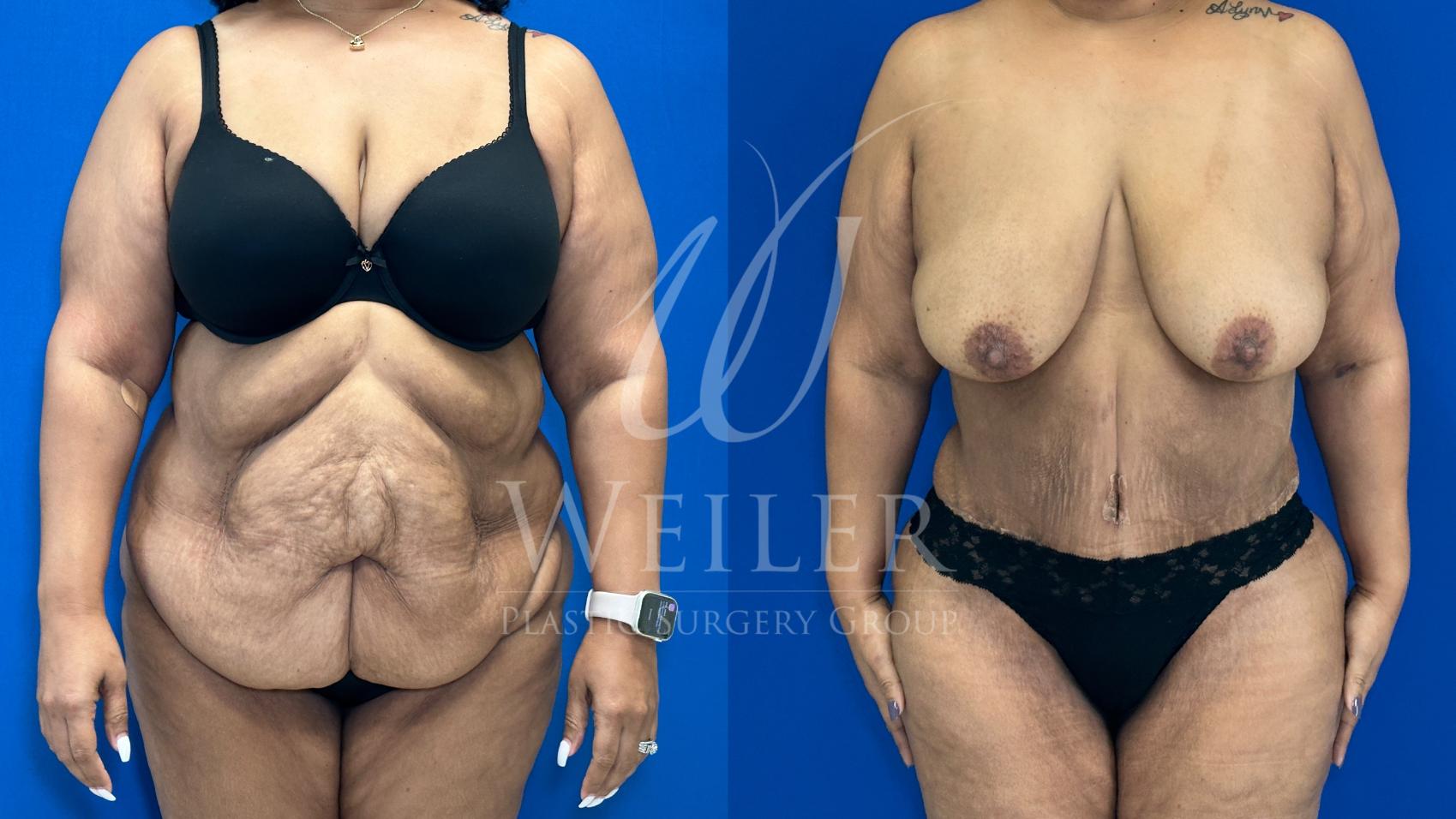 Before & After Tummy Tuck Case 1163 Front View in Baton Rouge, New Orleans, & Lafayette, Louisiana