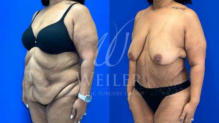 Before & After Tummy Tuck Case 1163 Right Oblique View in Baton Rouge, New Orleans, & Lafayette, Louisiana