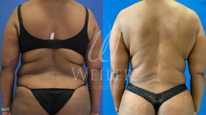 Before & After Tummy Tuck Case 1164 Back View in Baton Rouge, New Orleans, & Lafayette, Louisiana
