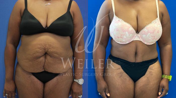Before & After Tummy Tuck Case 1164 Front View in Baton Rouge, New Orleans, & Lafayette, Louisiana