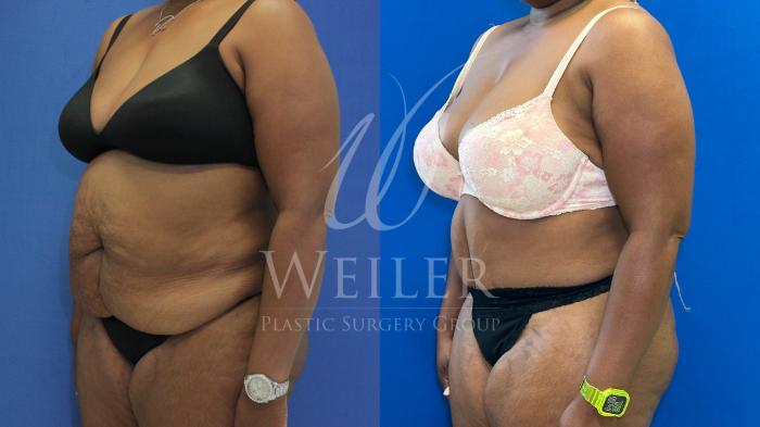 Before & After Tummy Tuck Case 1164 Right Oblique View in Baton Rouge, New Orleans, & Lafayette, Louisiana