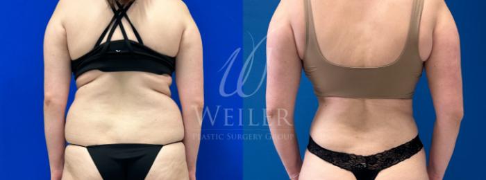 Before & After Tummy Tuck Case 1165 Back View in Baton Rouge, New Orleans, & Lafayette, Louisiana