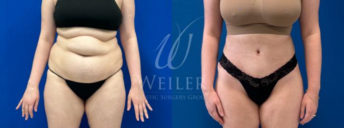 Before & After Tummy Tuck Case 1165 Front View in Baton Rouge, New Orleans, & Lafayette, Louisiana