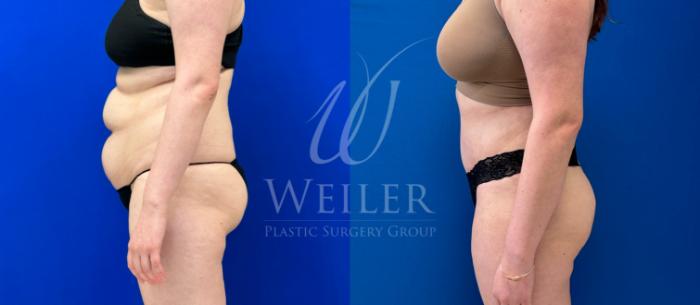 Before & After Tummy Tuck Case 1165 Left Side View in Baton Rouge, New Orleans, & Lafayette, Louisiana
