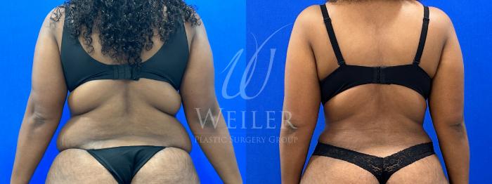 Before & After Tummy Tuck Case 1166 Back View in Baton Rouge, New Orleans, & Lafayette, Louisiana