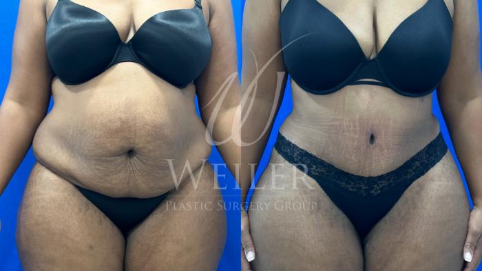Before & After Tummy Tuck Case 1166 Front View in Baton Rouge, New Orleans, & Lafayette, Louisiana