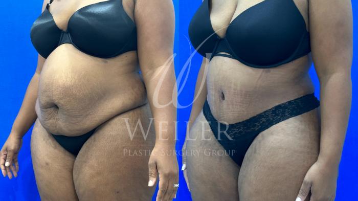 Before & After Tummy Tuck Case 1166 Right Oblique View in Baton Rouge, New Orleans, & Lafayette, Louisiana