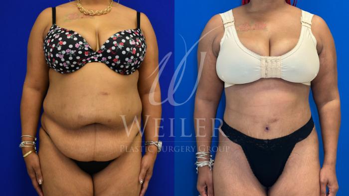 Before & After Tummy Tuck Case 1167 Front View in Baton Rouge, New Orleans, & Lafayette, Louisiana