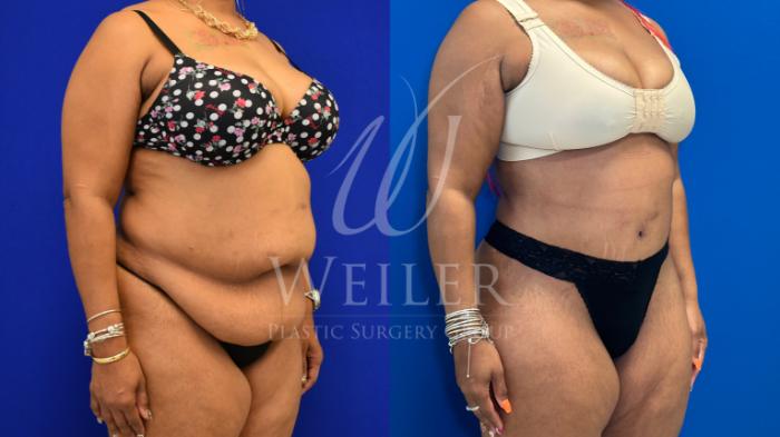 Before & After Tummy Tuck Case 1167 Left Oblique View in Baton Rouge, New Orleans, & Lafayette, Louisiana