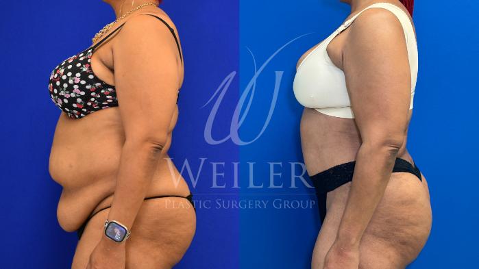Before & After Tummy Tuck Case 1167 Right Side View in Baton Rouge, New Orleans, & Lafayette, Louisiana