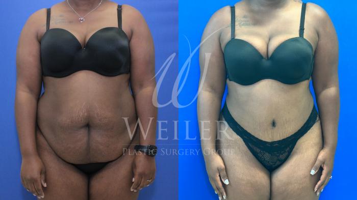 Before & After Tummy Tuck Case 1171 Front View in Baton Rouge, New Orleans, & Lafayette, Louisiana