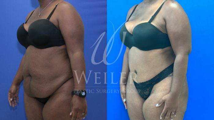Before & After Tummy Tuck Case 1171 Right Oblique View in Baton Rouge, New Orleans, & Lafayette, Louisiana