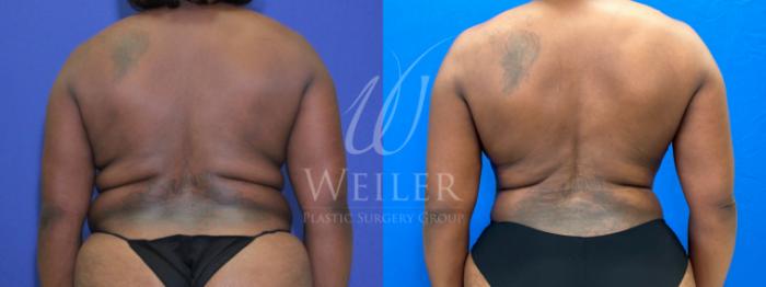 Before & After Tummy Tuck Case 1172 Back View in Baton Rouge, New Orleans, & Lafayette, Louisiana