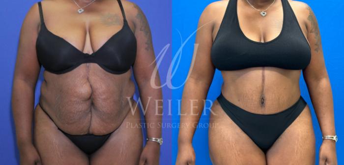 Before & After Tummy Tuck Case 1172 Front View in Baton Rouge, New Orleans, & Lafayette, Louisiana