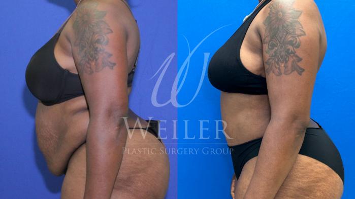 Before & After Tummy Tuck Case 1172 Right Side View in Baton Rouge, New Orleans, & Lafayette, Louisiana
