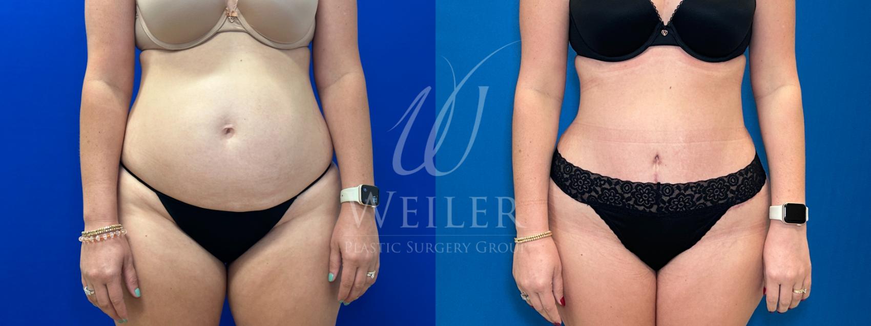 Before & After Tummy Tuck Case 1186 Front View in Baton Rouge, New Orleans, & Lafayette, Louisiana