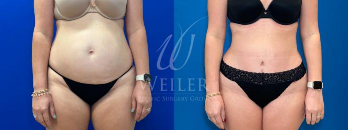 Before & After Tummy Tuck Case 1186 Front View in Baton Rouge, New Orleans, & Lafayette, Louisiana