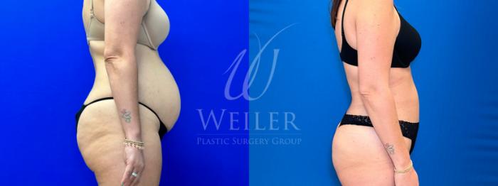 Before & After Tummy Tuck Case 1186 Right Side View in Baton Rouge, New Orleans, & Lafayette, Louisiana