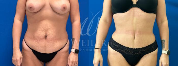 Before & After Tummy Tuck Case 1193 Front View in Baton Rouge, New Orleans, & Lafayette, Louisiana