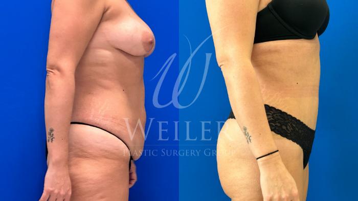 Before & After Tummy Tuck Case 1193 Left Side View in Baton Rouge, New Orleans, & Lafayette, Louisiana