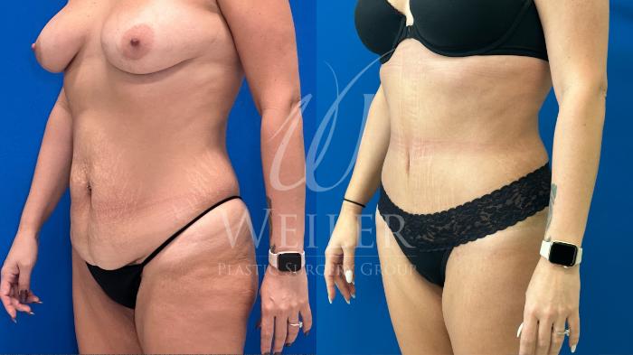 Before & After Tummy Tuck Case 1193 Right Oblique View in Baton Rouge, New Orleans, & Lafayette, Louisiana