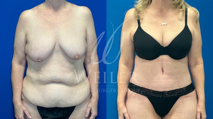 Before & After Tummy Tuck Case 1212 Front View in Baton Rouge, New Orleans, & Lafayette, Louisiana