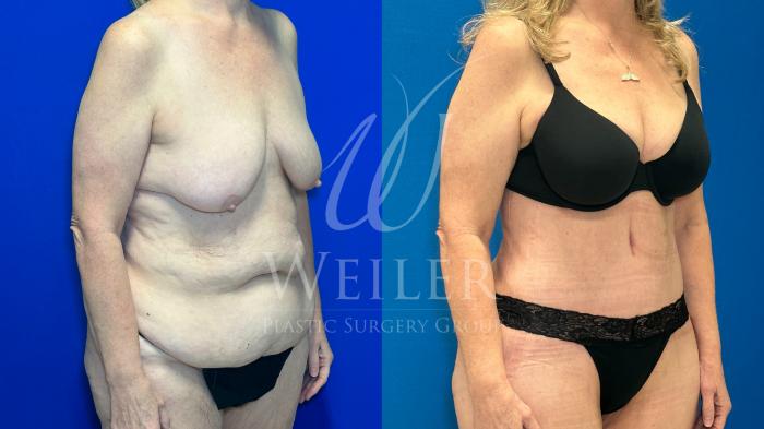 Before & After Tummy Tuck Case 1212 Left Oblique View in Baton Rouge, New Orleans, & Lafayette, Louisiana