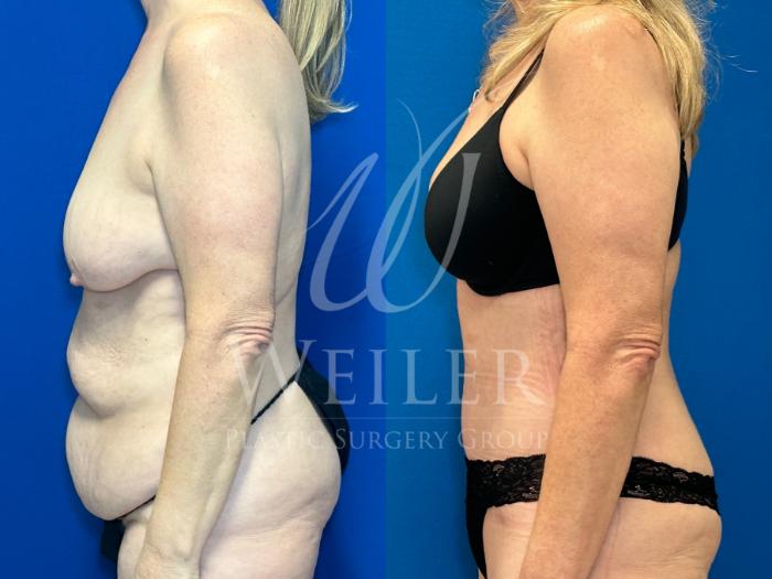 Before & After Tummy Tuck Case 1212 Right Side View in Baton Rouge, New Orleans, & Lafayette, Louisiana
