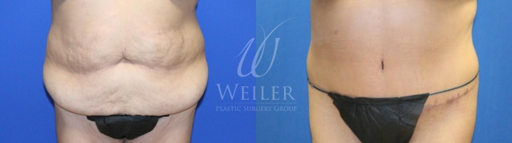 Before & After Tummy Tuck Case 1213 Front View in Baton Rouge, New Orleans, & Lafayette, Louisiana