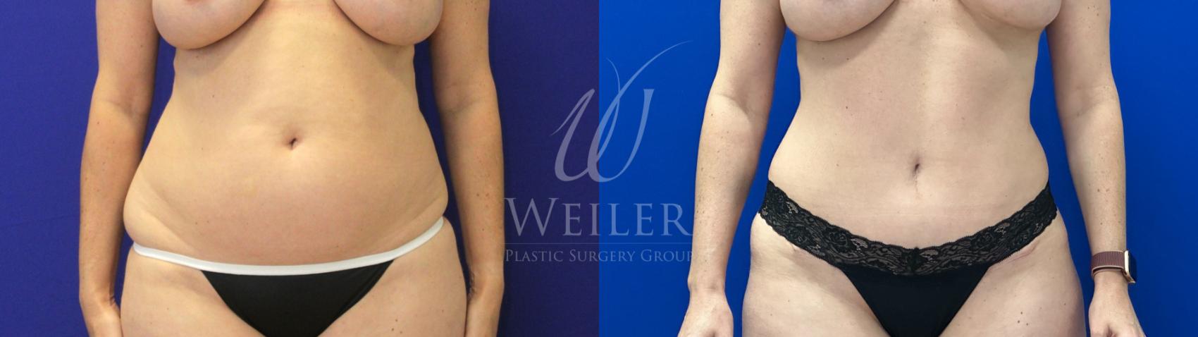 Before & After Tummy Tuck Case 1226 Front View in Baton Rouge, New Orleans, & Lafayette, Louisiana