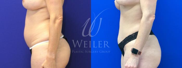 Before & After Tummy Tuck Case 1226 Left Side View in Baton Rouge, New Orleans, & Lafayette, Louisiana