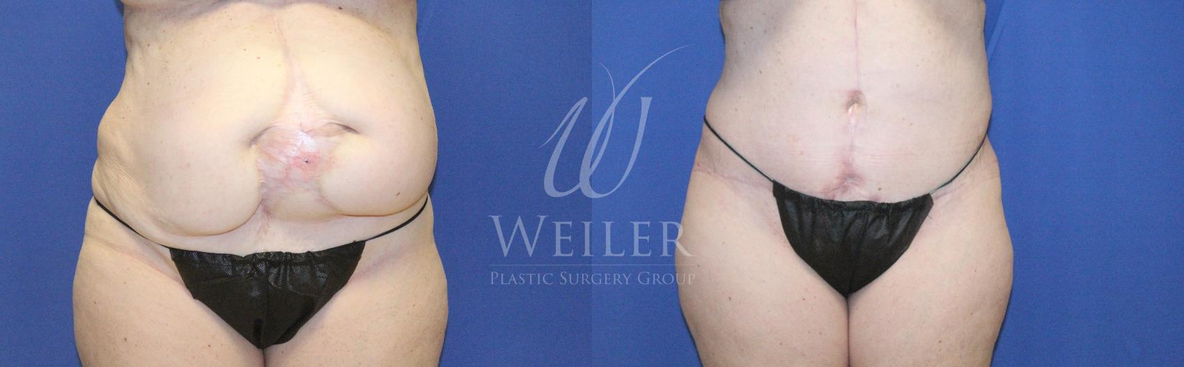 Before & After Tummy Tuck Case 1235 Front View in Baton Rouge, New Orleans, & Lafayette, Louisiana