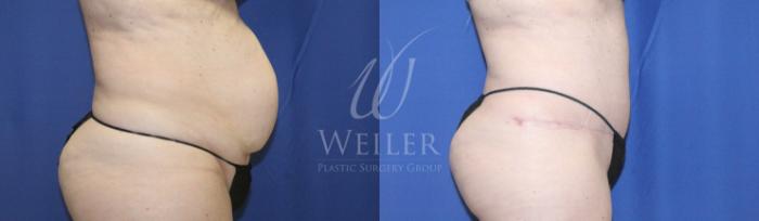 Before & After Tummy Tuck Case 1235 Left Side View in Baton Rouge, New Orleans, & Lafayette, Louisiana