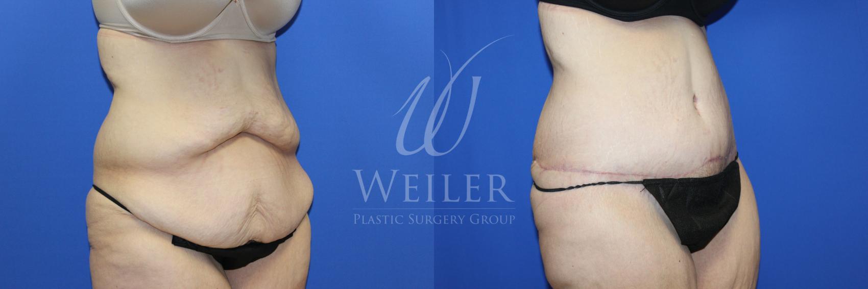 Before & After Tummy Tuck Case 1239 Left Oblique View in Baton Rouge, New Orleans, & Lafayette, Louisiana