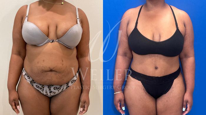 Before & After Tummy Tuck Case 1247 Front View in Baton Rouge, New Orleans, & Lafayette, Louisiana