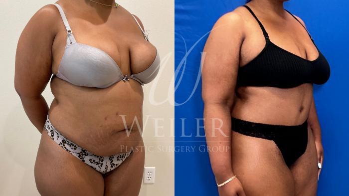 Before & After Tummy Tuck Case 1247 Left Oblique View in Baton Rouge, New Orleans, & Lafayette, Louisiana