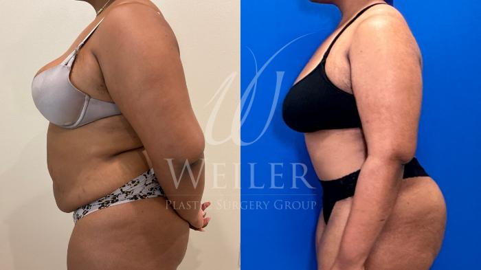 Before & After Tummy Tuck Case 1247 Right Side View in Baton Rouge, New Orleans, & Lafayette, Louisiana