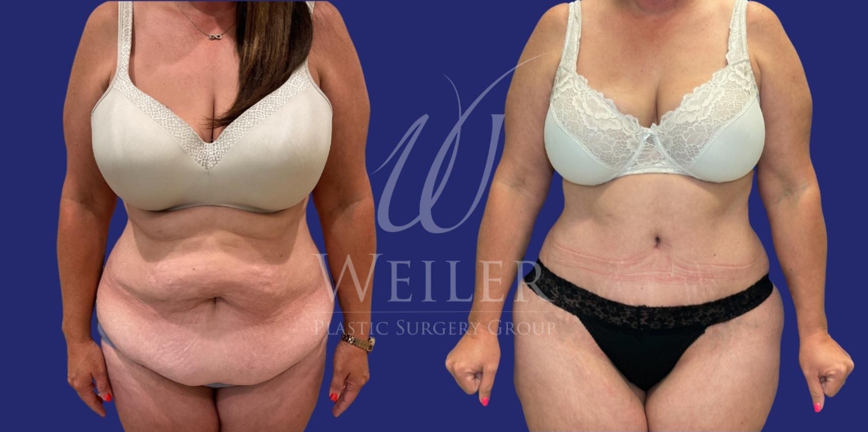 Before & After Tummy Tuck Case 1248 Front View in Baton Rouge, New Orleans, & Lafayette, Louisiana