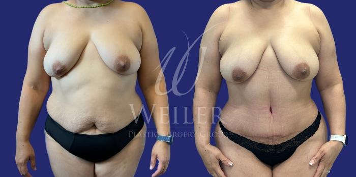 Before & After Tummy Tuck Case 1251 Front View in Baton Rouge, New Orleans, & Lafayette, Louisiana