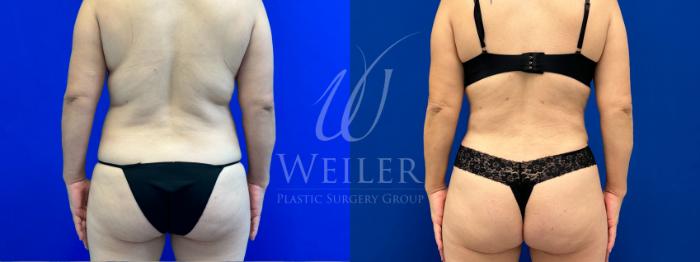 Before & After Tummy Tuck Case 1261 Back View in Baton Rouge, New Orleans, & Lafayette, Louisiana
