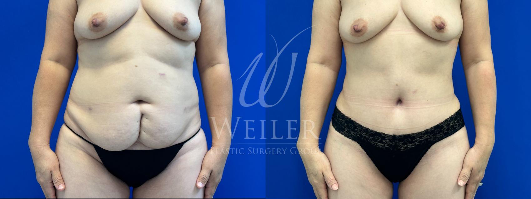 Before & After Tummy Tuck Case 1261 Front View in Baton Rouge, New Orleans, & Lafayette, Louisiana